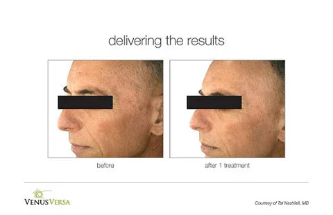 IPL Photofacial