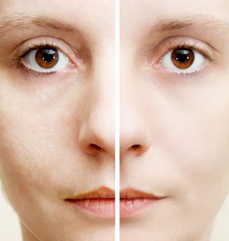 Anti-Wrinkle Injections – Precision, Protection, and Proven Results