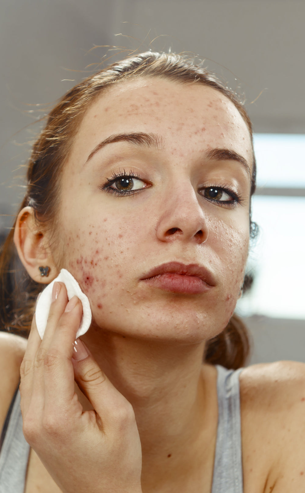 From Breakouts to Redness: Understanding Your Skin’s Story”