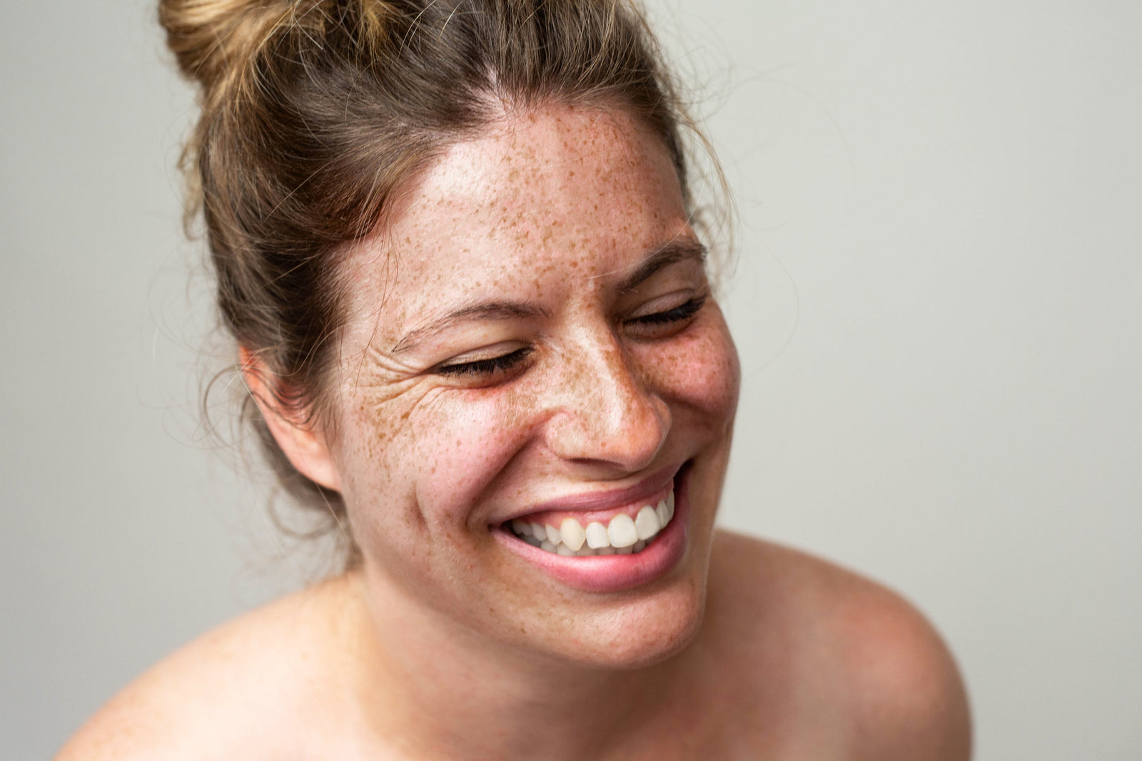 Skin Peels- Chemical Peels