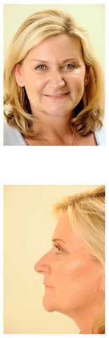 Radio frequency : By Venus Concept