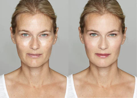 Venus Versa Facial Treatment Results Blog Post