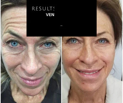 Skin rejuvenation, healing and collagen synthesis