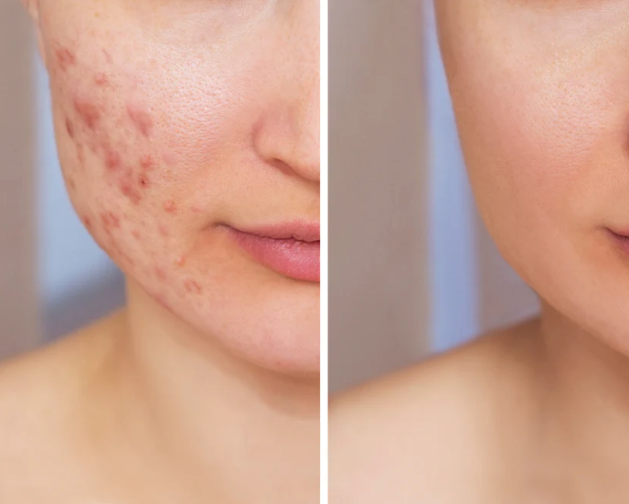 Microneedling: The Power of Collagen Stimulation