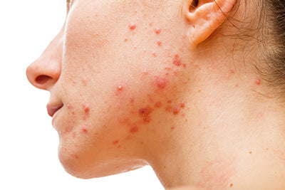 Acne - Causes and Treatment Options