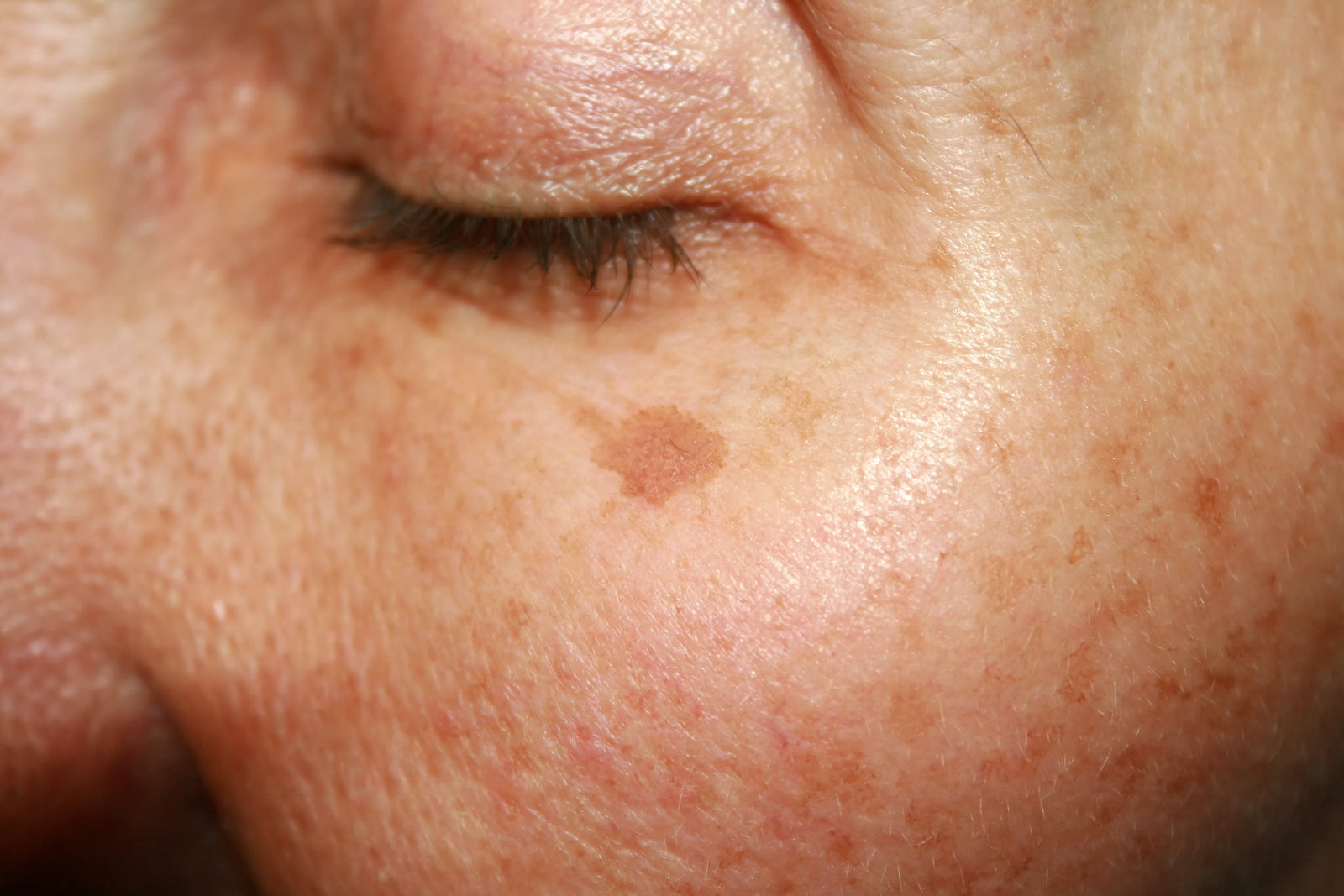 Hyperpigmentation - Causes & Treatments