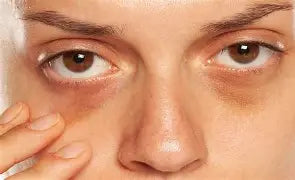 Discolouration and Dark Circles Under the Eyes
