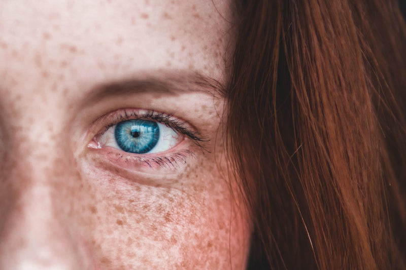 Acne-Rosacea