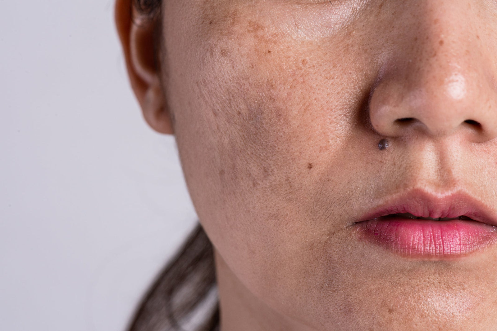 Pigmentation & Discolouration