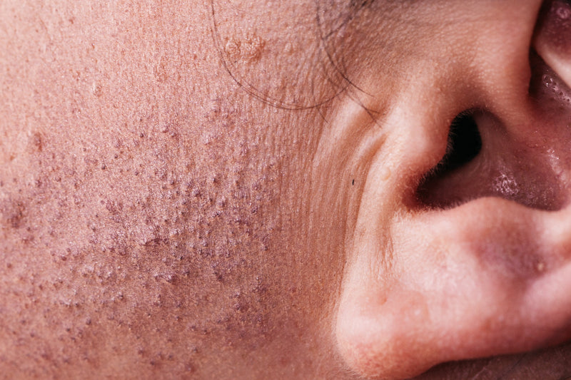 What are sebaceous filaments and how to get rid of them?