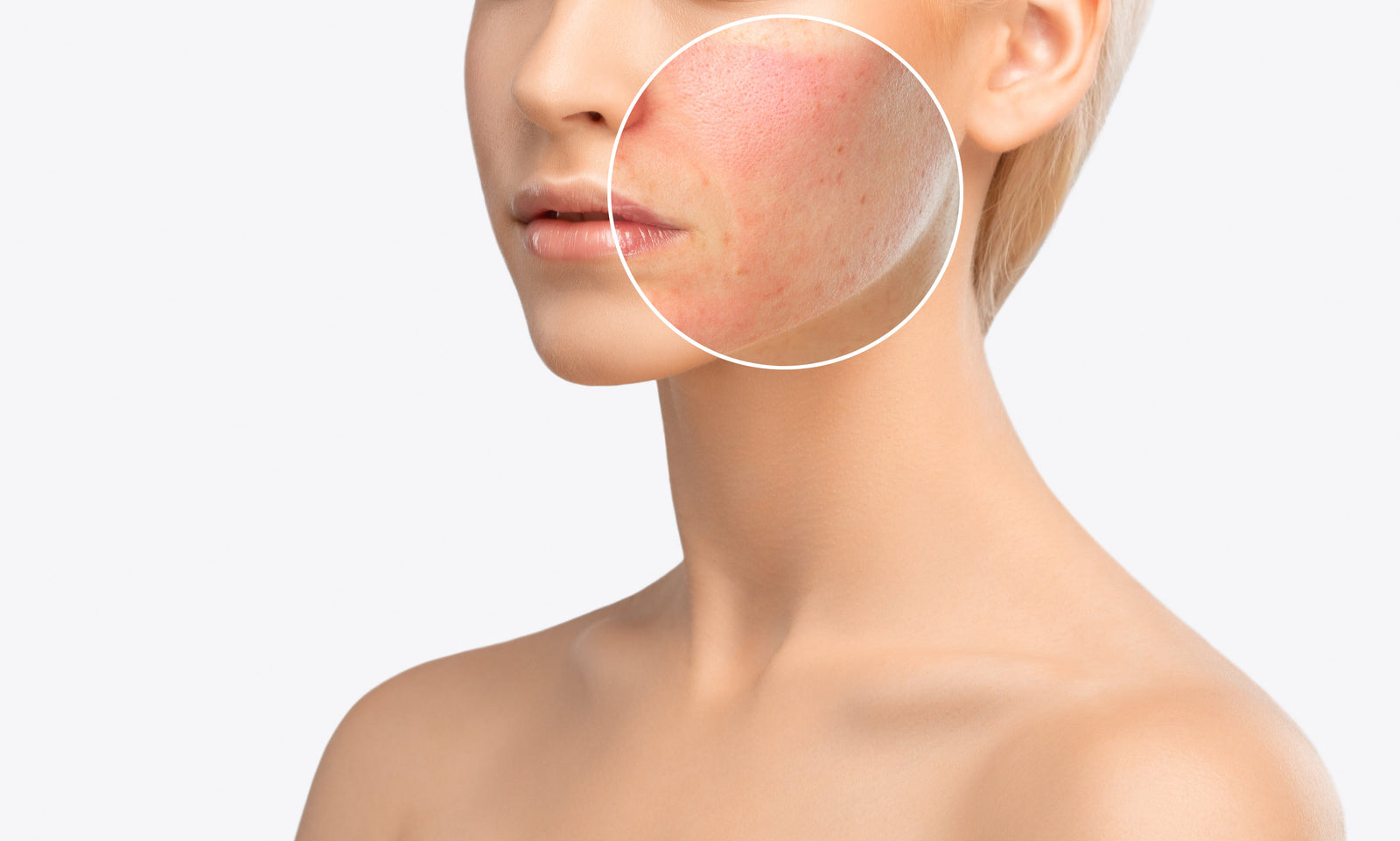 Compromised skin barrier