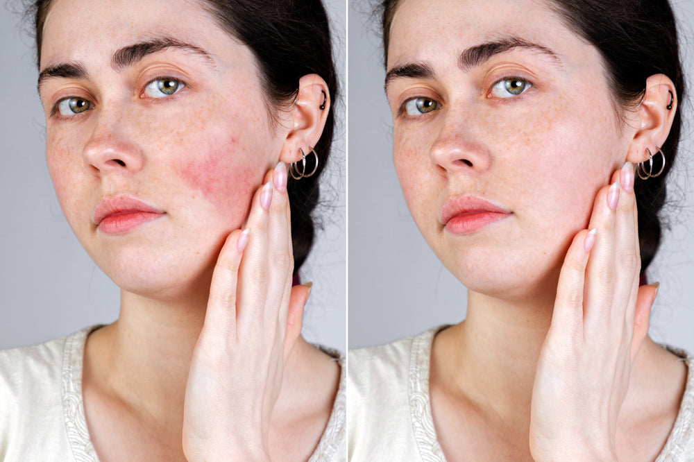 Rosacea Skin Care