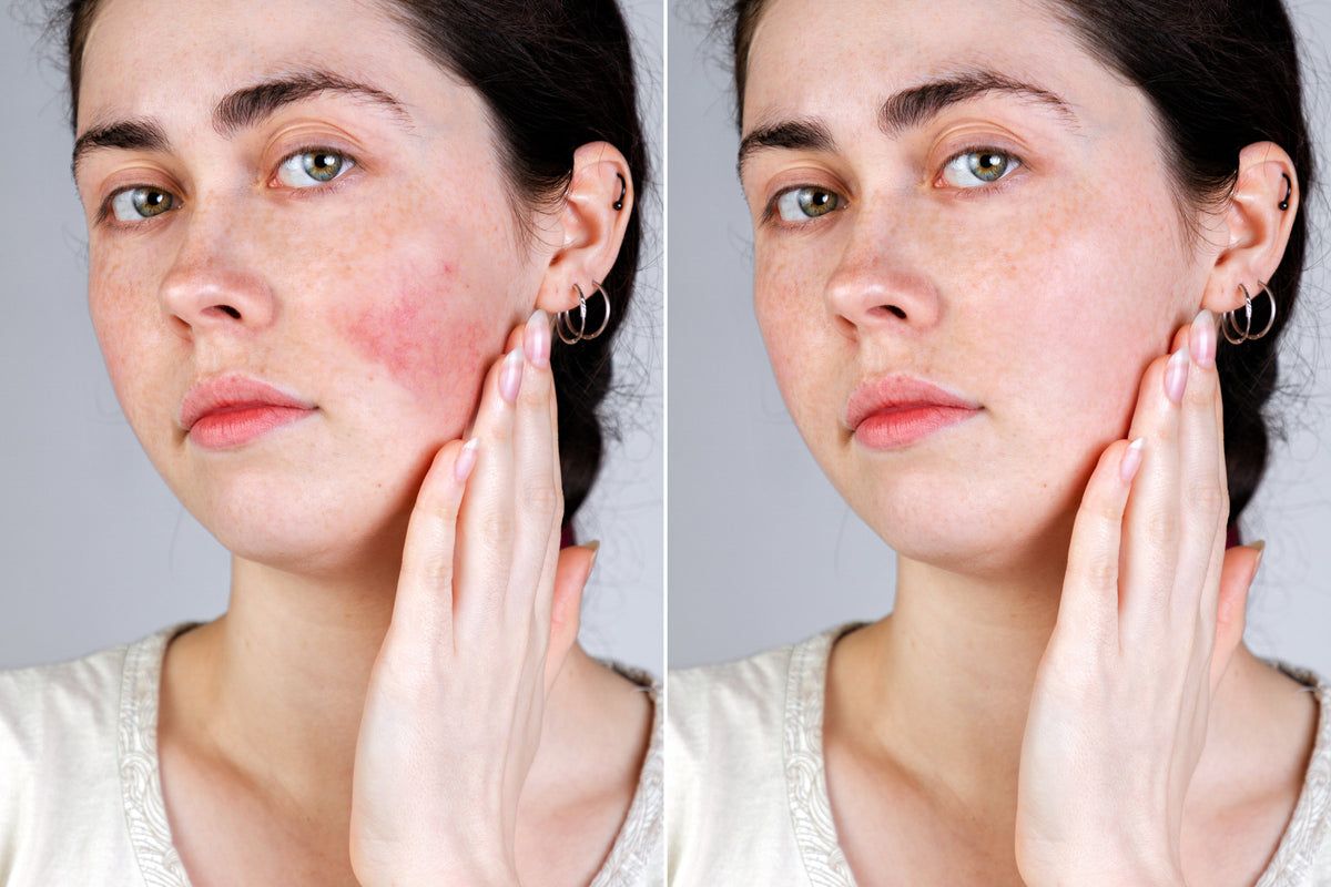 Rosacea Skin Care