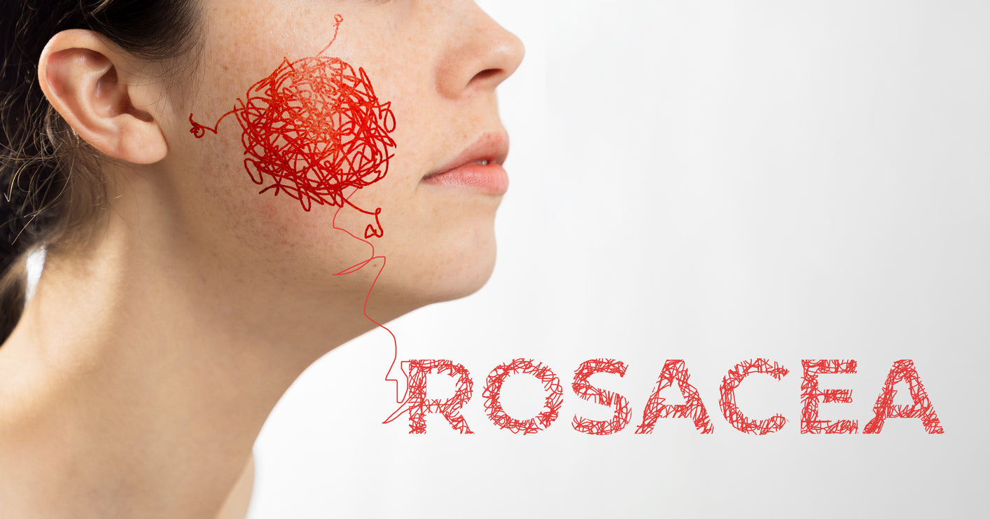 Understanding Rosacea