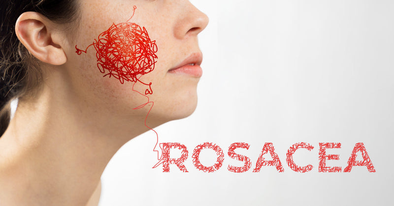 Understanding Rosacea
