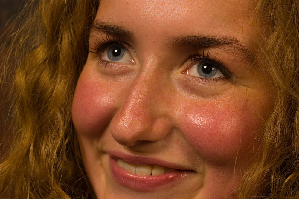 Rosacea: Understanding, Managing, and Healing Sensitive Skin