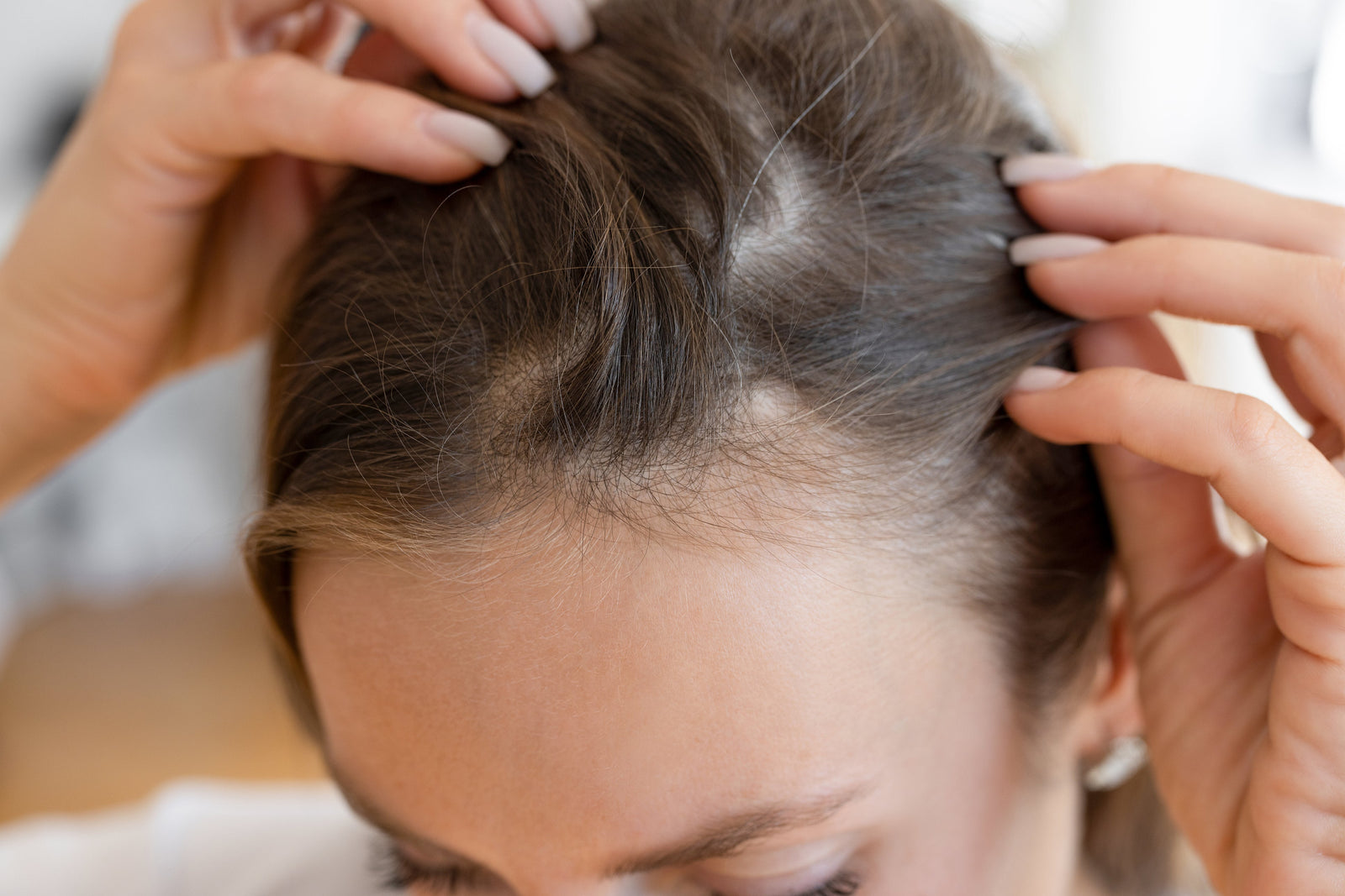 Help for breakouts on the hairline and scalp
