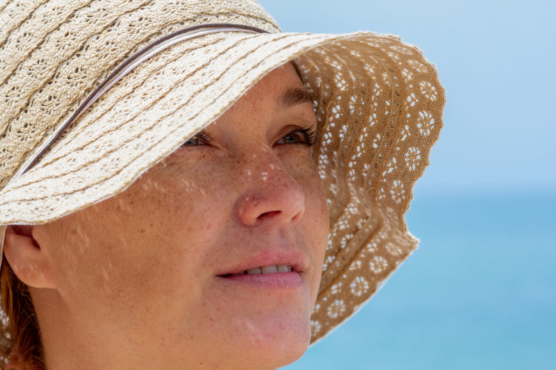 Freckles and Sun Damage: Why Daily SPF Is Essential for Preventing Pigmentation and Premature Ageing
