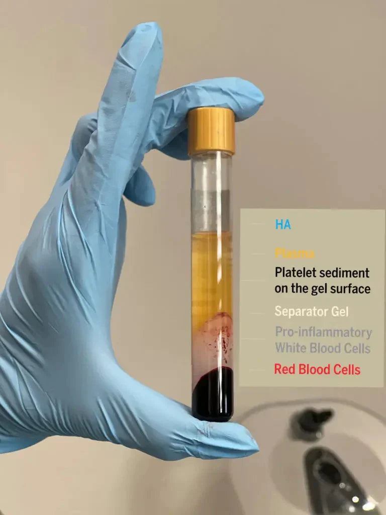 Platelet-Rich Plasma (PRP) Information