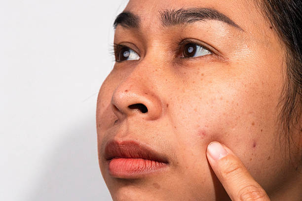 What is Acne?