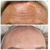 CELLULAR REJUVENATION FACIAL CELLSTORY LIQUID MICRONEEDLING –no needles or equipment.