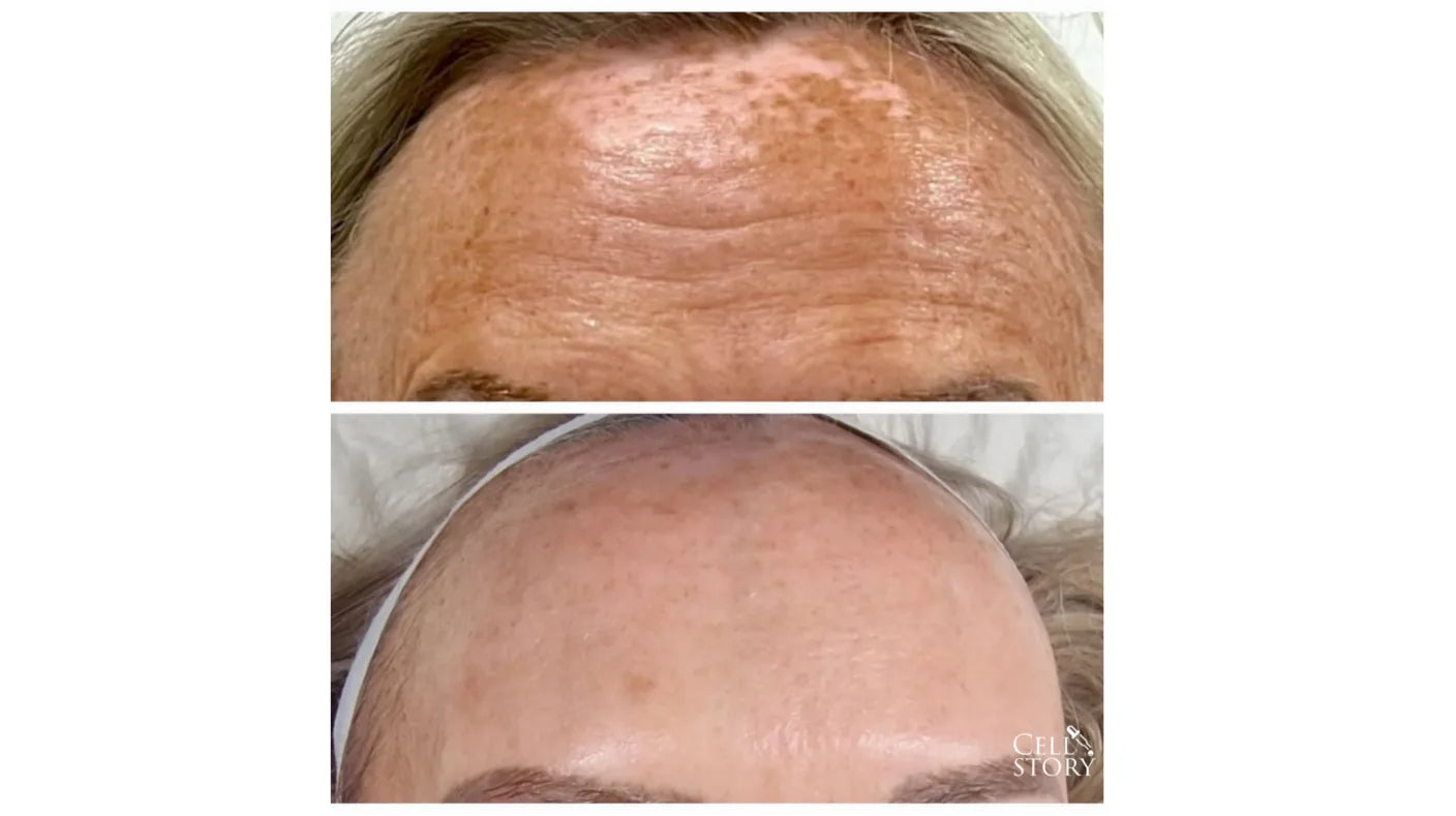 CELLULAR REJUVENATION FACIAL CELLSTORY LIQUID MICRONEEDLING –no needles or equipment.