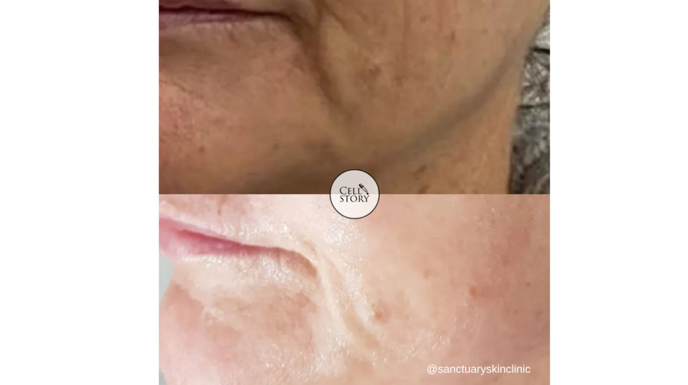 CELLULAR REJUVENATION FACIAL CELLSTORY LIQUID MICRONEEDLING –no needles or equipment.