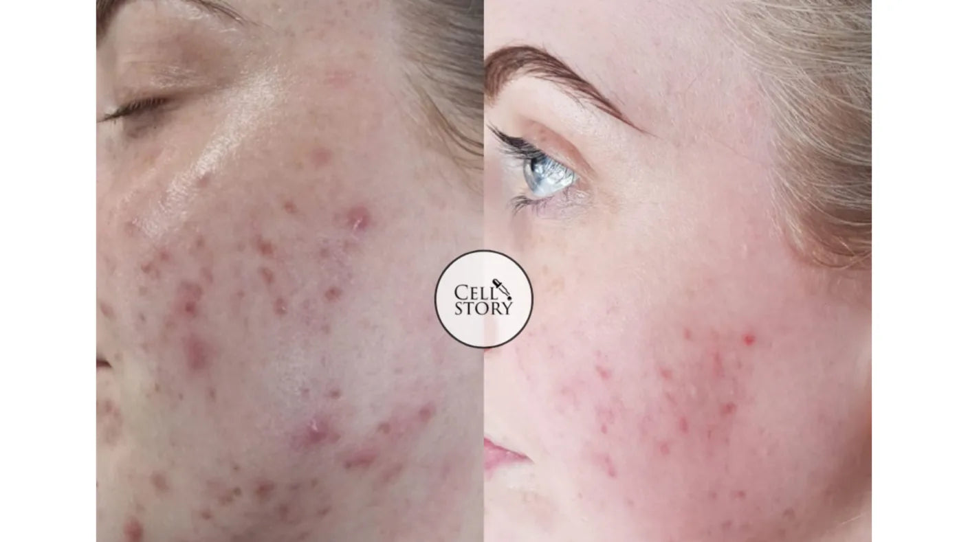 CELLULAR REJUVENATION FACIAL CELLSTORY LIQUID MICRONEEDLING –no needles or equipment.